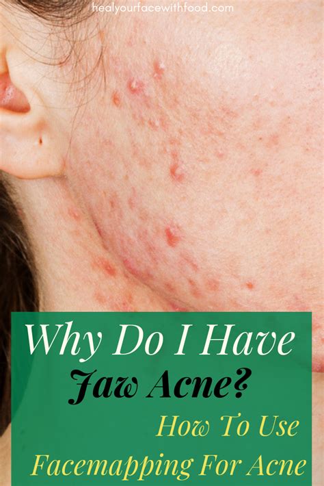 Cystic Acne On Jawline Sylviaweems