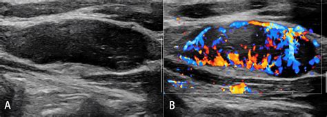 Frontiers Ultrasound Elastography For The Evaluation Of Lymph Nodes