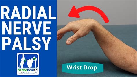 Radial Nerve Palsy Wrist Drop Evaluation Youtube