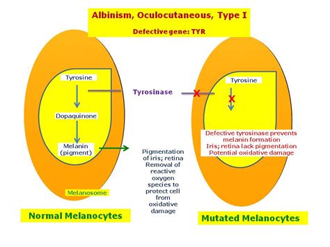 Albinism Oculocutaneous Type I Hereditary Ocular Diseases