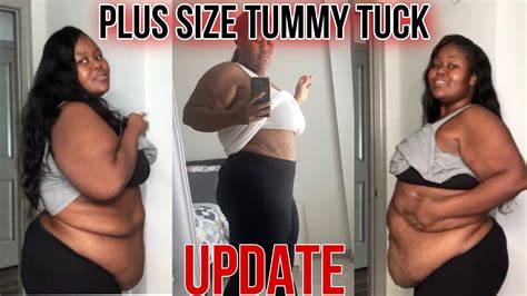 Plus Size Tummy Tuck Update Youtube
