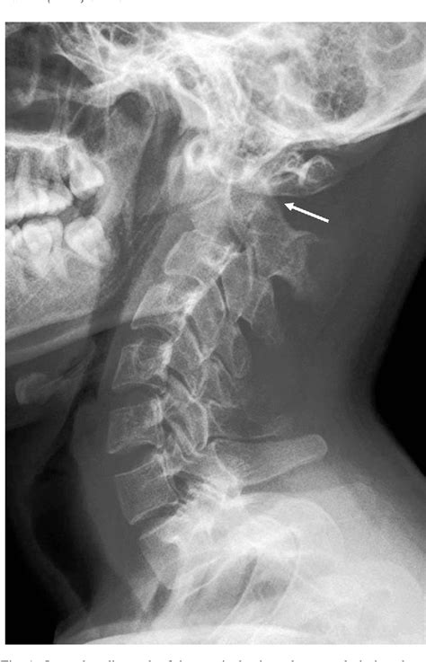 Figure 1 From Cervical Tuberculosis Associated With Cervical Pain And