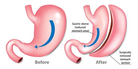 Gastric Sleeve Plano Tx Texas Center For Bariatrics And Advanced Surgery