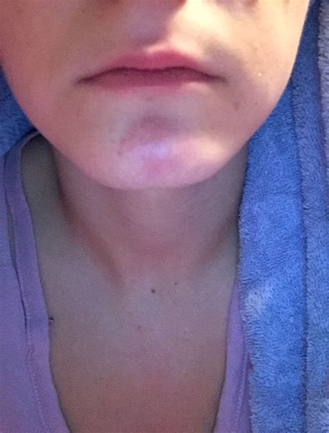 What Is This Hard Red Lump On My Chin Rosacea And Facial Redness Forum