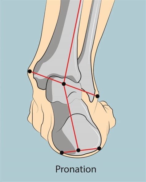 The Treatment And Cause Of Overpronation Of The Foot Ava Beitel