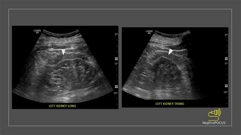The ‘double Line Sign Nephropocus