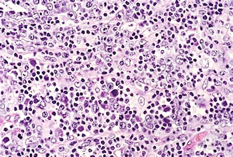 It sometimes causes a rash. Angioimmunoblastic T Cell Lymphoma - 7.