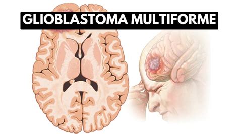 inside glioblastoma multiforme a journey into the deadliest brain tumor youtube