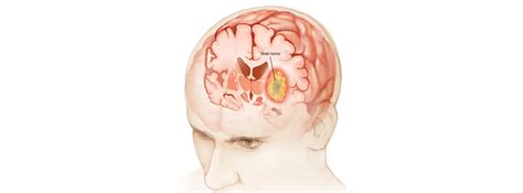 Brain Cancer Its Causes Symptoms And Treatment Bmchrc