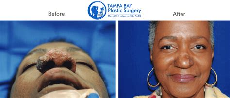 Reconstructive Surgery Procedures At Tampa Bay Plastic Surgery