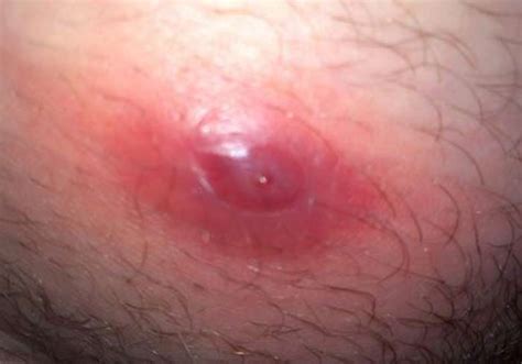 The bump can progress into a rash, blister, cyst or boil. Ingrown Hair Cyst, Removal, Won't go Away, Under Skin ...