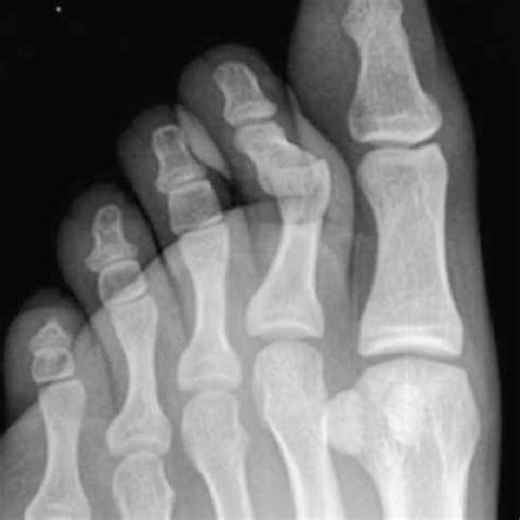 Photograph Of The Left Second Toe Proximal Interphalangeal Joint