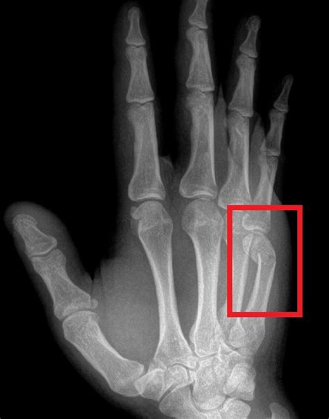 Hand Pain After Punching A Wall It Could Be A Boxers Fracture