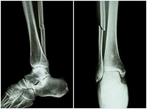 Fracture Shaft Of Fibula Bone Leg Bone X Ray Of Leg 2 Position