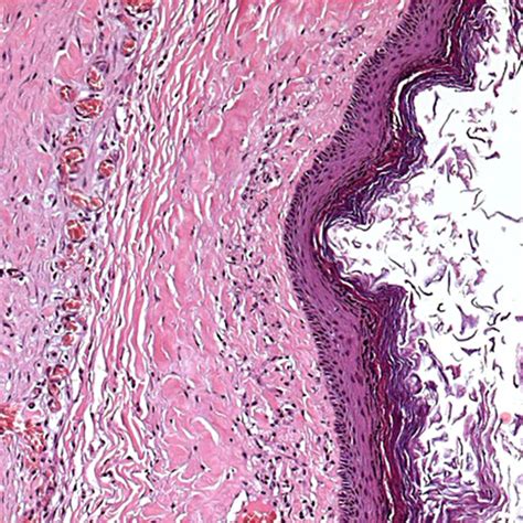 Photomicrograph Of The Cyst Wall Showing A Stratified Squamous