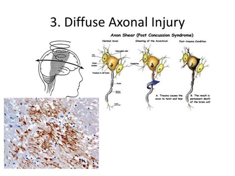 Grade 3 Diffuse Axonal Injury Islero Guide Answer For Assignment