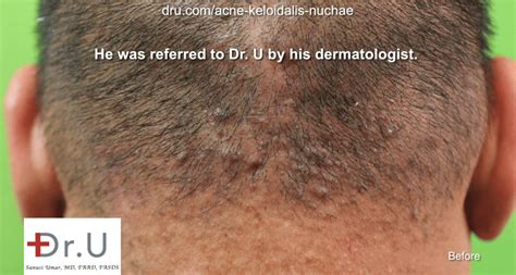 Video Los Angeles Acne Keloidalis Nuchae Laser Treatment Cure By Dr U