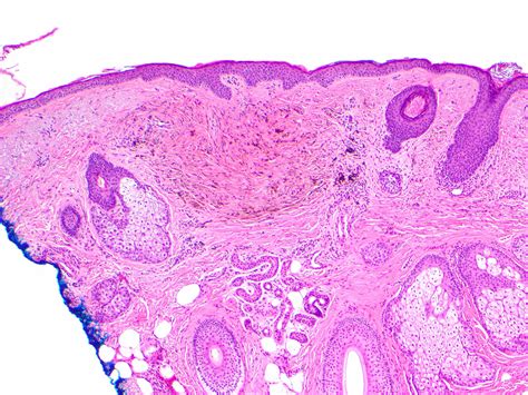 Blue Nevus Histology