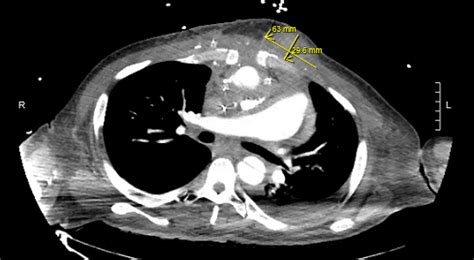 Chest Ct Scan With Iv Contrast Axial View Showing 63 Cm × 296 Cm