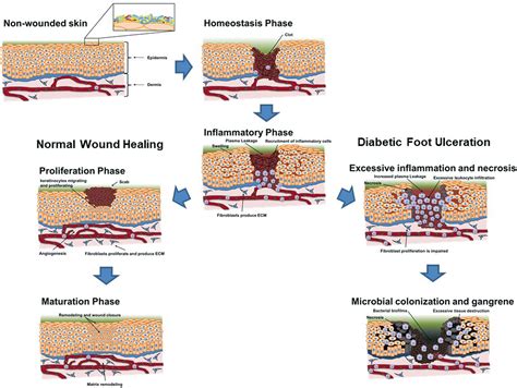 Diabetic Foot Ulcer Healing Process Diabeteswalls