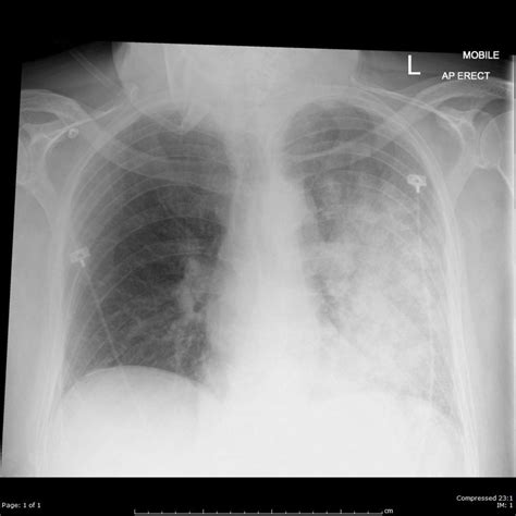 Unilateral Pulmonary Oedema Bmj Case Reports