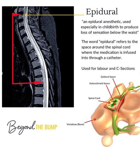 Spinal Block Vs Epidural What Is The Difference Beyond The Bump