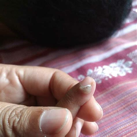 My 2 Year Old Son Has Some Kind Of Skin Growth Near Finger Nail With No