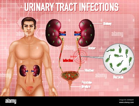 Informative Illustration Of Urinary Tract Infections Stock Vector Image