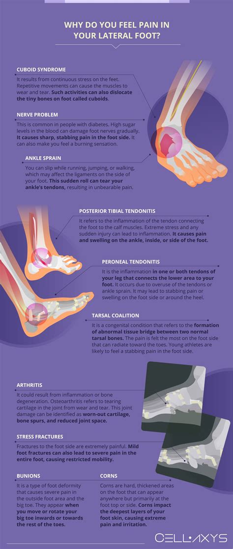 10 Causes Of Stabbing Pain In Foot Side Cellaxys