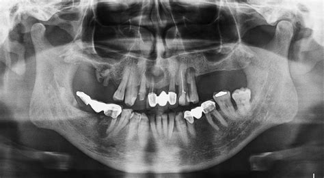 Dental Dento Metric Radiología Maxilofacial Y Oral