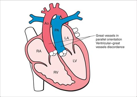 Complete And Congenitally Corrected Transposition Of The Great Arteries