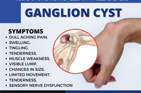Ganglion Cyst Wrist Treatment Dr Nasirphysiotherapy And Rehabilation