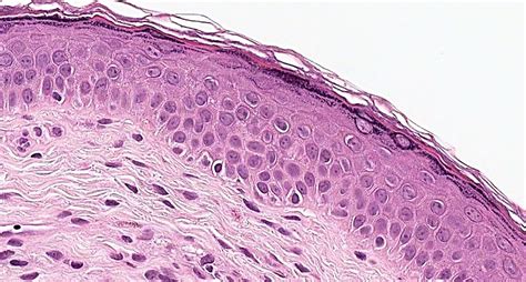 What Are Squamous Cells Mypathologyreportca