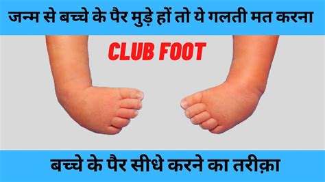 जन्म से बच्चे के मुड़े हुए पैर कैसे ठीक करें Clubfoot In Hindi Congenital Talipes