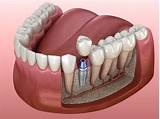 Dental Implants | Dental Veneers | Inverness Family Dentistry