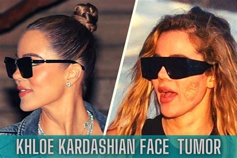 khloe kardashian had tumor removed from her face what type of cancer did she have