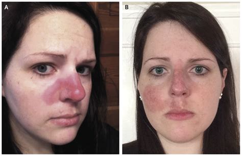 Cutaneous Lupus — “the Pimple That Never Went Away” Nejm