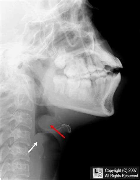 Learning Radiology Epiglottitis