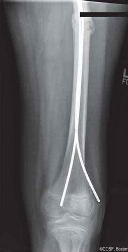 Flexible Intramedullary Nailing Femur Musculoskeletal Key