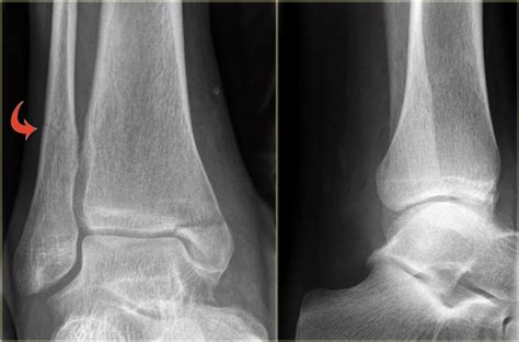 The Radiology Assistant Ankle Fractures Weber And Lauge Hansen