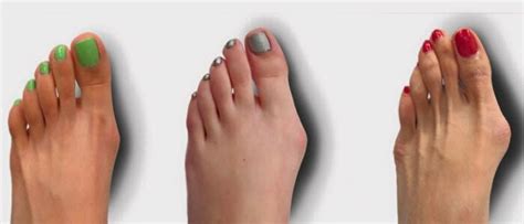 With wide feet, wearing shoes that don't fit properly isn't just a matter of comfort. Everything You Need to Know if You Have Bunions ...