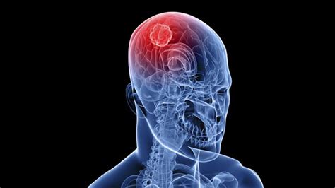 Take up space inside the skull when they grow cause specific symptoms due to the position of the tumour in the brain Brain tumors may occur in children with the common genetic ...