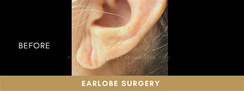 Earlobe Surgery Plastic Eye Surgery Associates