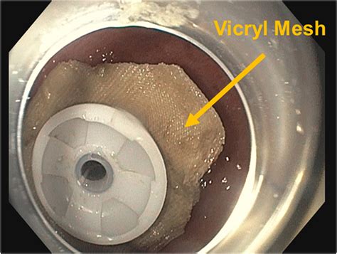 Case Series Use Of Vicryl Mesh In The Management Of Gi Fistulas And