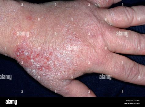 Itchy Rashes On Hands