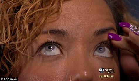 Doctor Behind Tiny Harris Ice Grey Colored Eye Implants Explains How