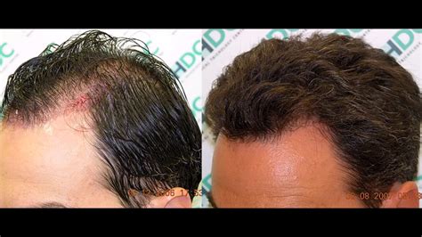 Ways To Regrow Lost Hair How To Apply Apple Cider Vinegar For Hair
