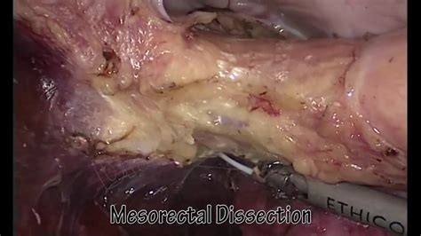 Low Anterior Bowel Resection Hot Sex Picture