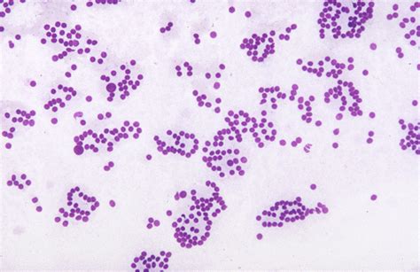 Pathology Outlines Follicular Neoplasm