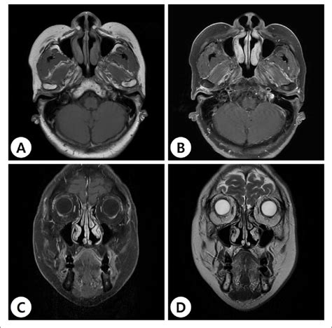 Postoperative Paranasal Sinus Magnetic Resonance Images T1 Weighted